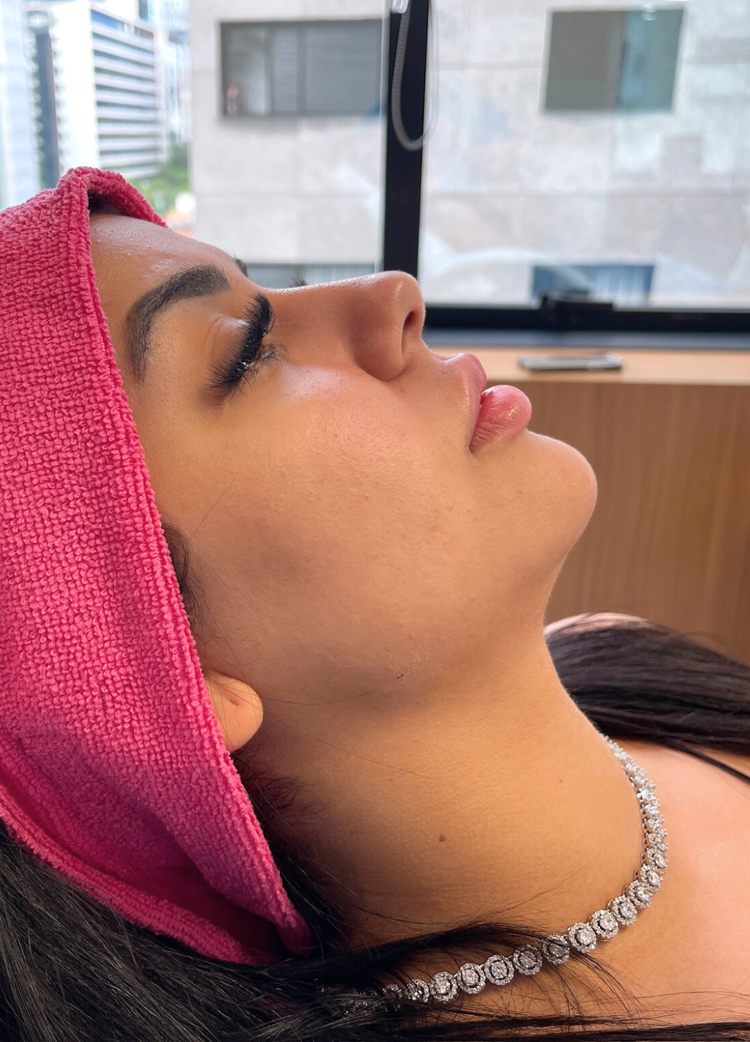 Preenchimento Labial (Fran) — antes