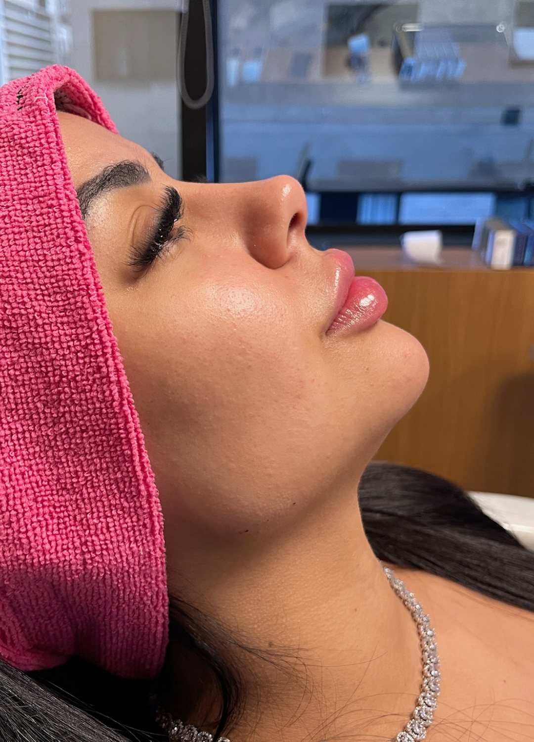 Preenchimento Labial (Fran) — depois