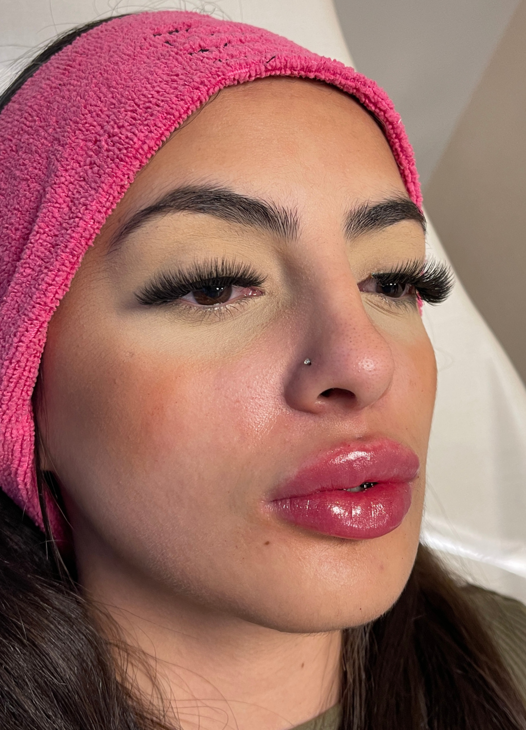 Preenchimento Labial (Paloma) — depois