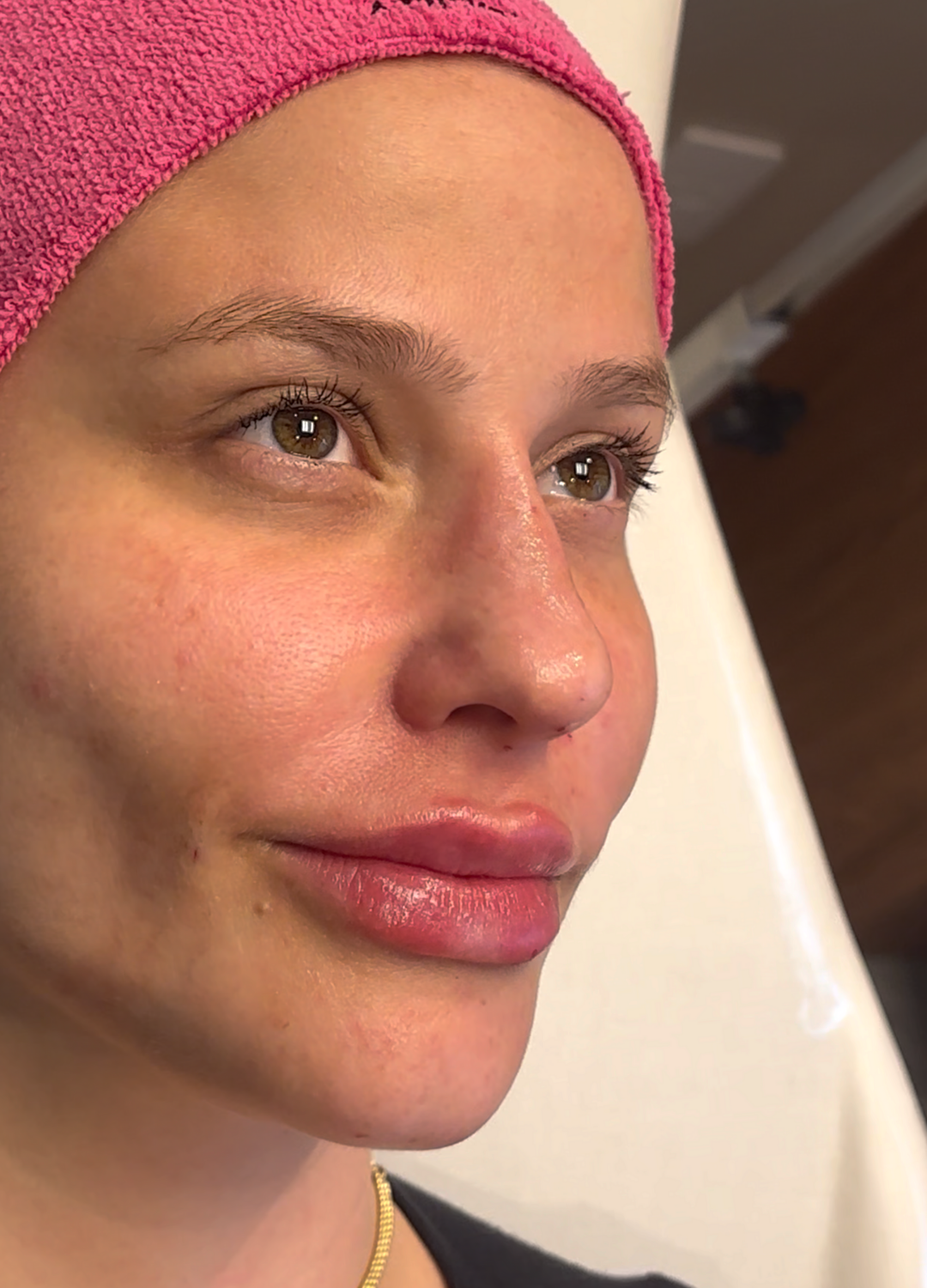 Preenchimento Labial (Thayne) — depois