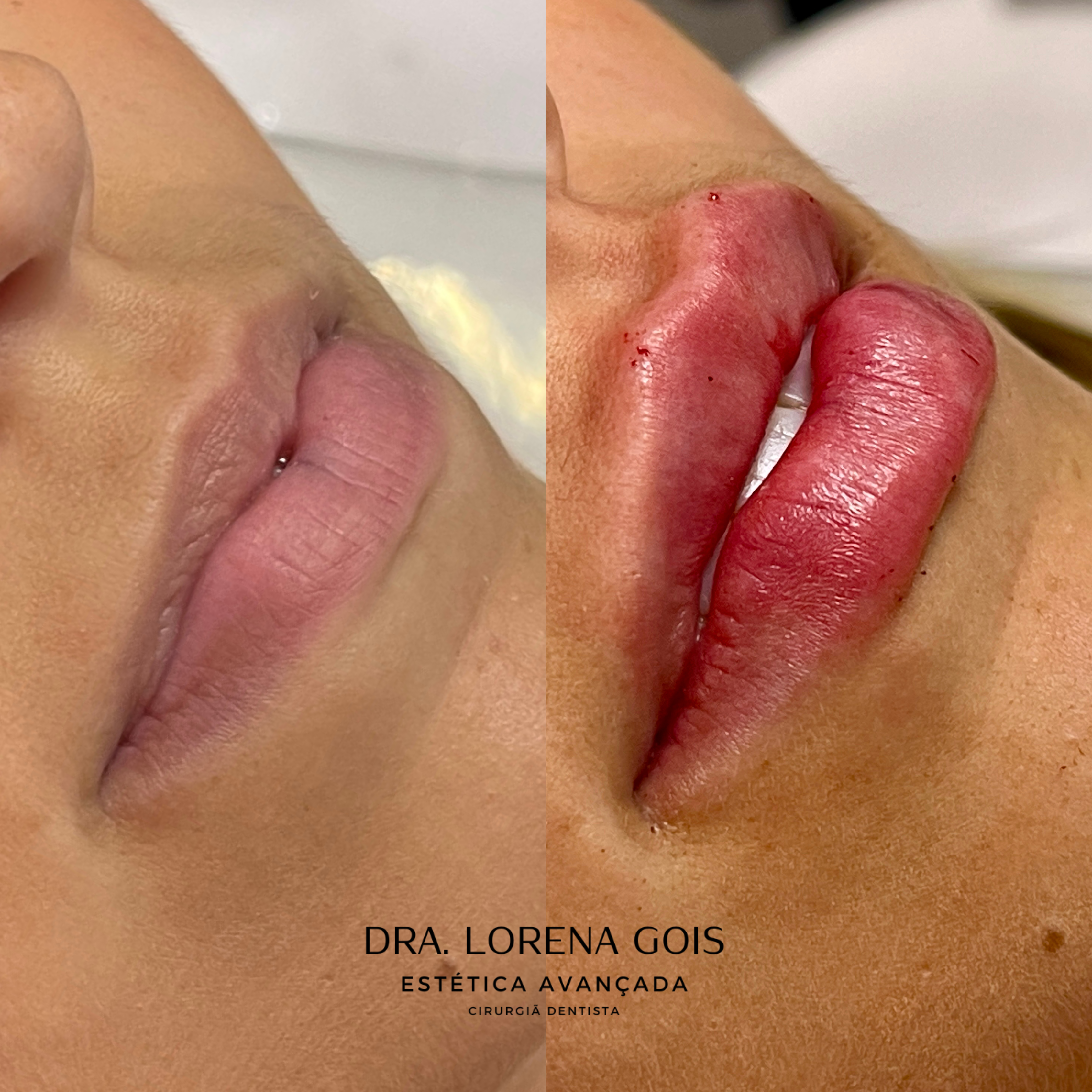 Preenchimento Labial