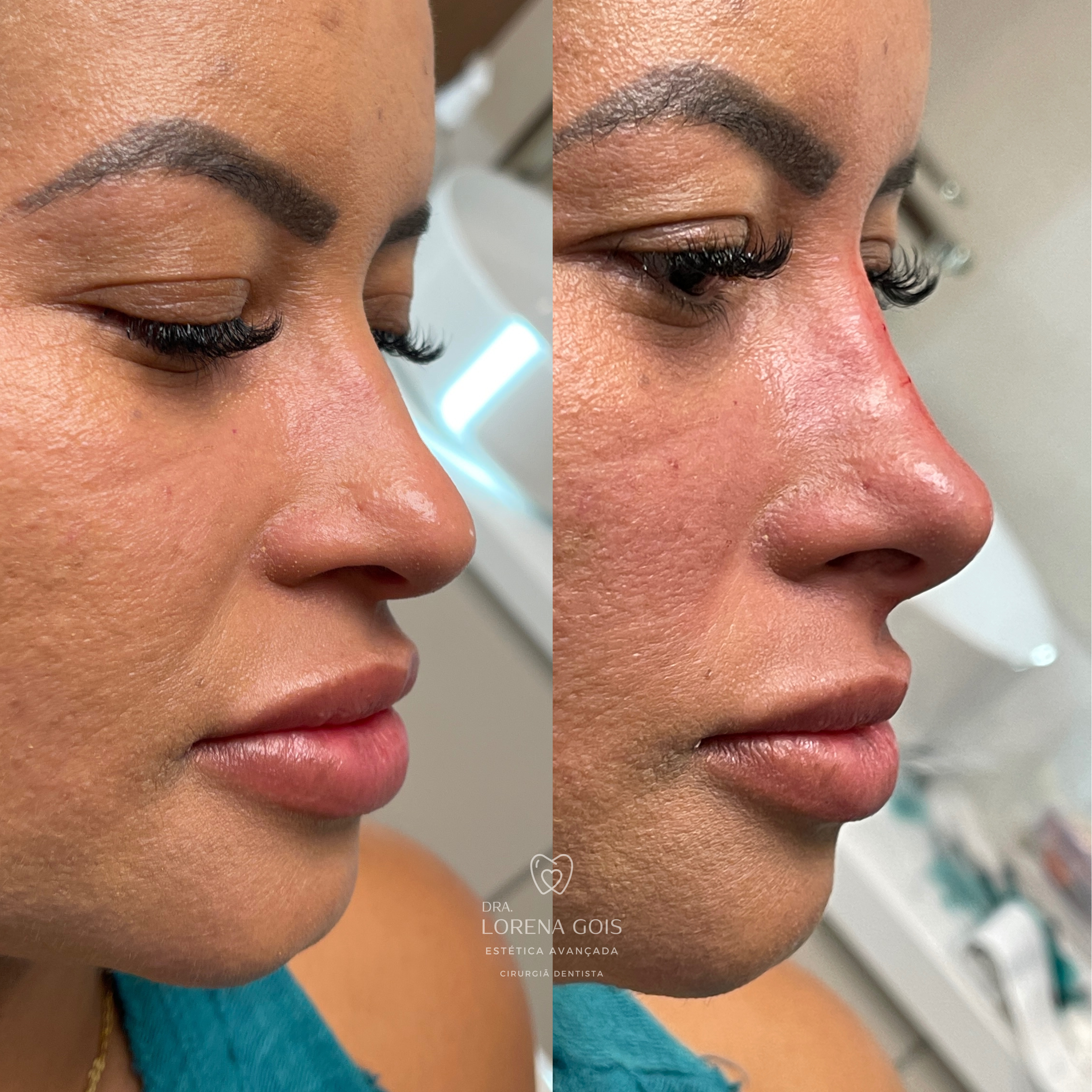 [Antes x Depois] - [Rino] - [Laís] - [Feed] - 2 - 2024